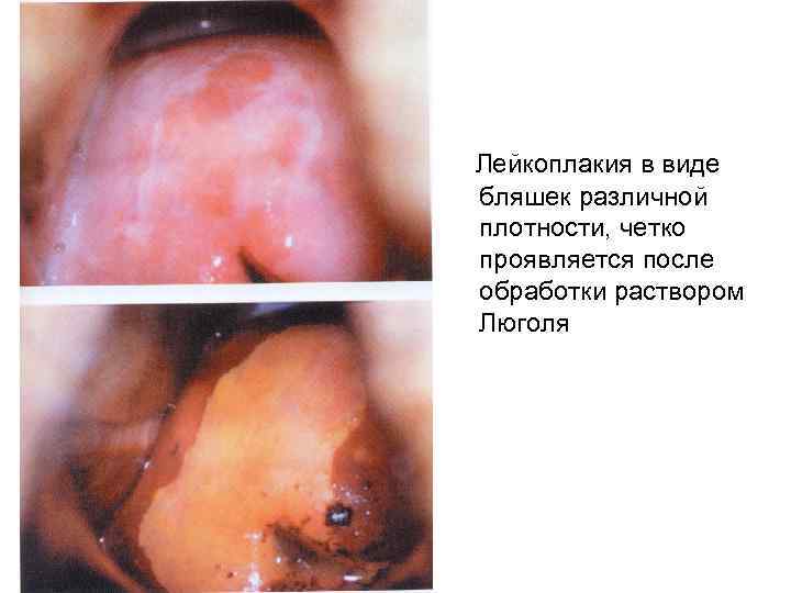 Лейкоплакия в виде бляшек различной плотности, четко проявляется после обработки раствором Люголя 