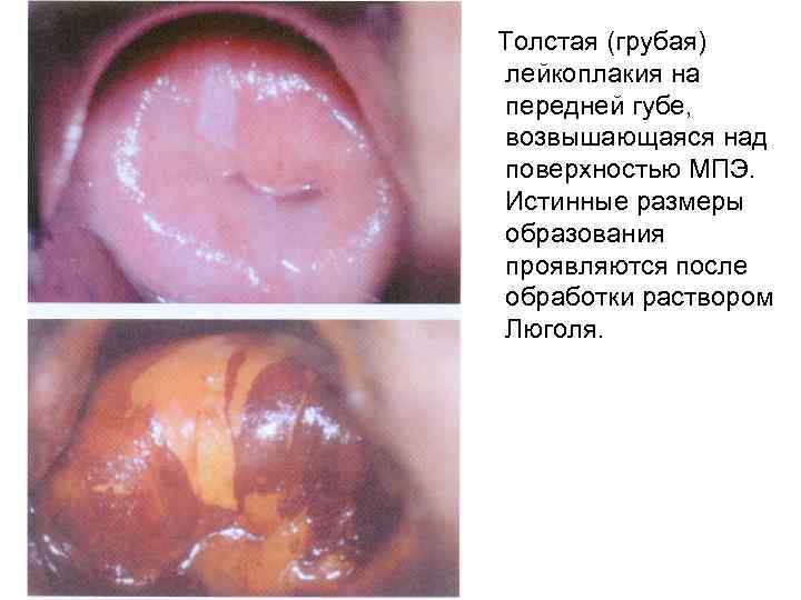 Толстая (грубая) лейкоплакия на передней губе, возвышающаяся над поверхностью МПЭ. Истинные размеры образования проявляются