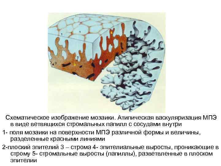 Схематическое изображение мозаики. Атипическая васкуляризация МПЭ в виде ветвящихся стромальных папилл с сосудами внутри