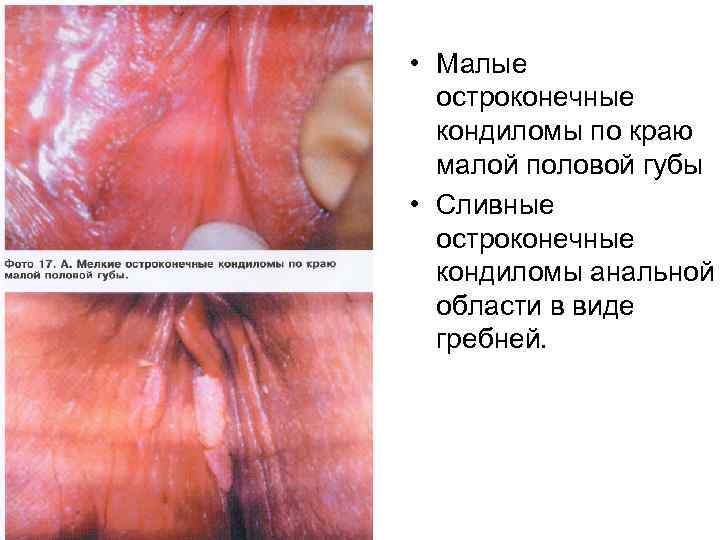  • Малые остроконечные кондиломы по краю малой половой губы • Сливные остроконечные кондиломы