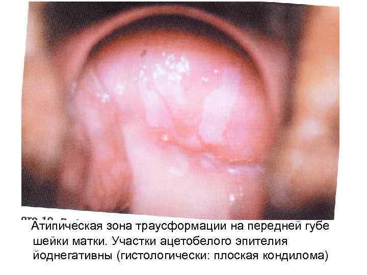 Атипическая зона траусформации на передней губе шейки матки. Участки ацетобелого эпителия йоднегативны (гистологически: плоская