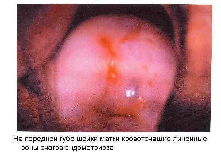 На передней губе шейки матки кровоточащие линейные зоны очагов эндометриоза 