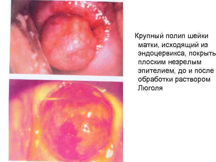 Крупный полип шейки матки, исходящий из эндоцервикса, покрыты плоским незрелым эпителием, до и после
