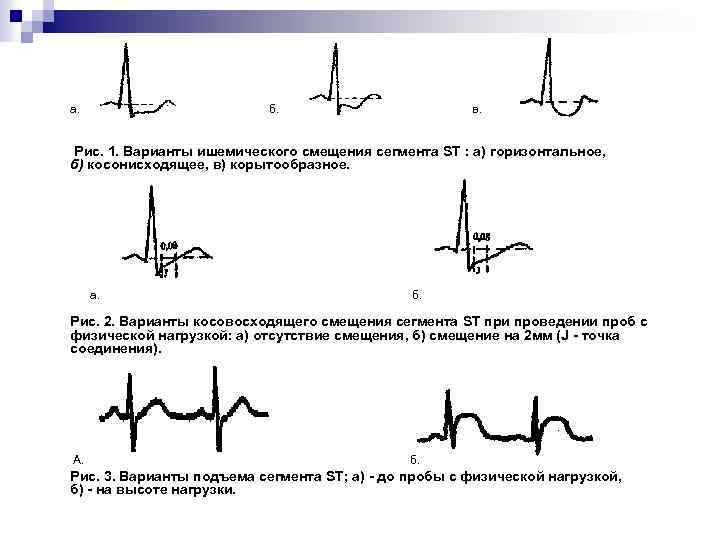 St на экг. Корытообразный сегмент St на ЭКГ. Ишемическое смещение сегмента St что это такое. Корытообразное смещение St. Косонисходящая депрессия сегмента St.