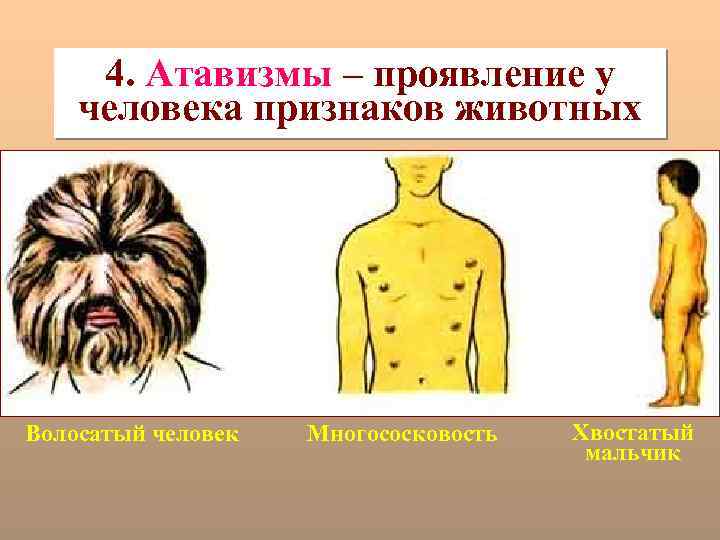 4. Атавизмы – проявление у человека признаков животных Волосатый человек Многососковость Хвостатый мальчик 