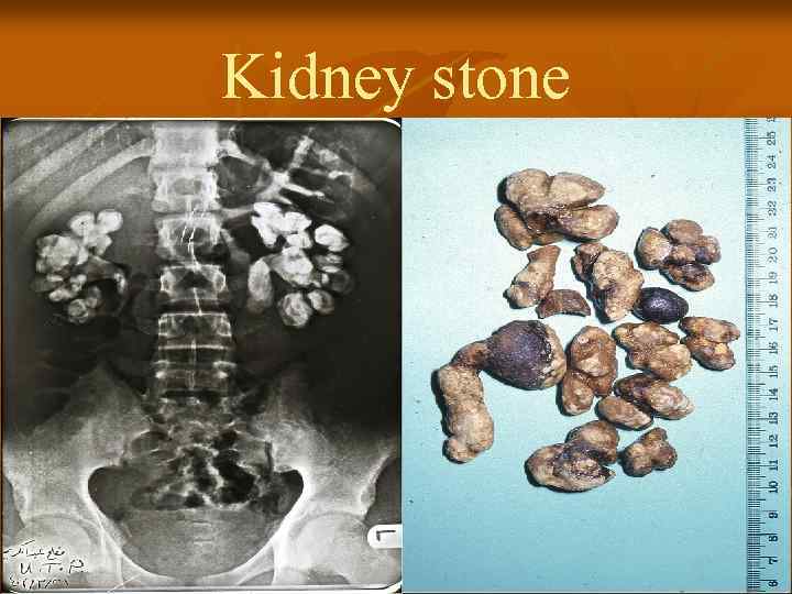Kidney stone 