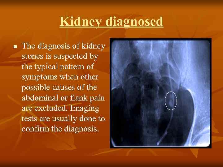 Kidney diagnosed n The diagnosis of kidney stones is suspected by the typical pattern