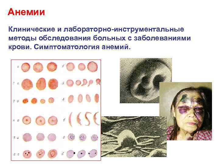 Анемии Клинические и лабораторно инструментальные методы обследования больных с заболеваниями крови. Симптоматология анемий. 