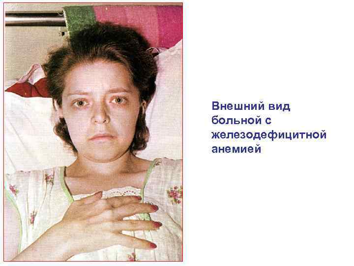 Внешний вид больной с железодефицитной анемией 