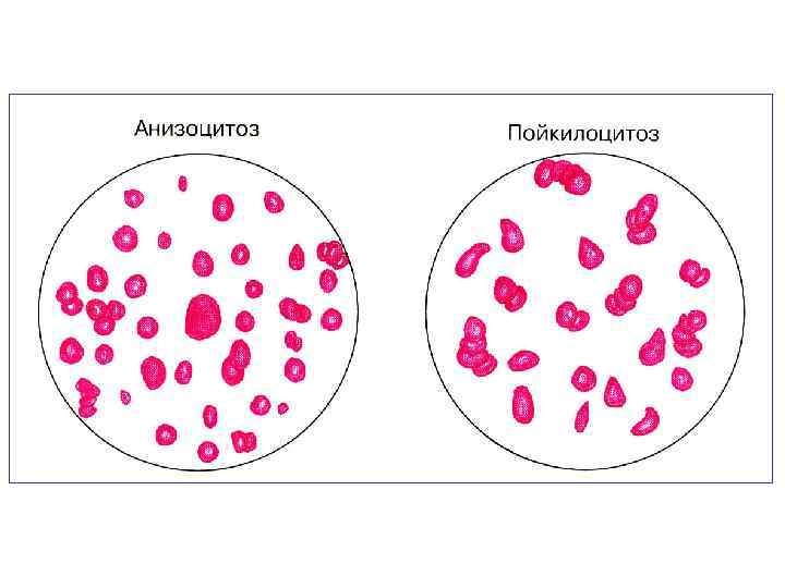 Анизоцитоз микро незначительный