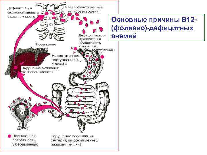 Основные причины В 12 (фолиево) дефицитных анемий 