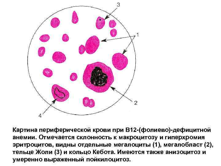 Анемия в12 дефицитная анемия картина крови