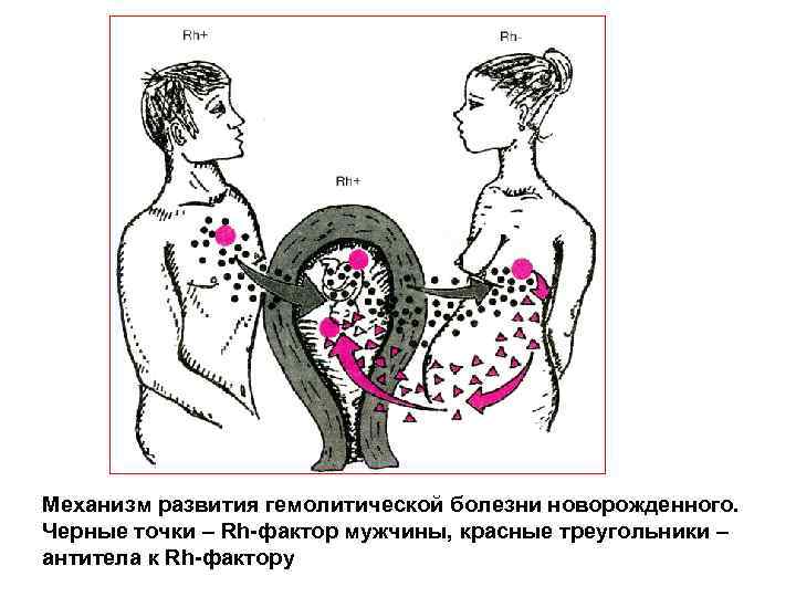 Механизм развития гемолитической болезни новорожденного. Черные точки – Rh фактор мужчины, красные треугольники –