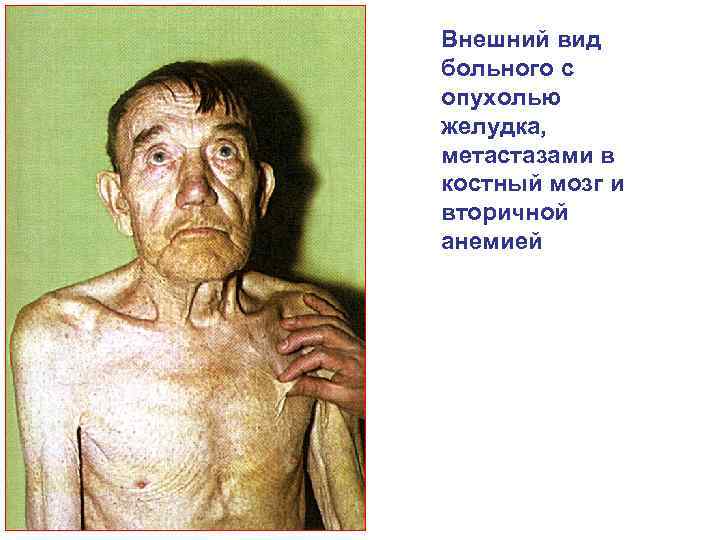 Внешний вид больного с опухолью желудка, метастазами в костный мозг и вторичной анемией 