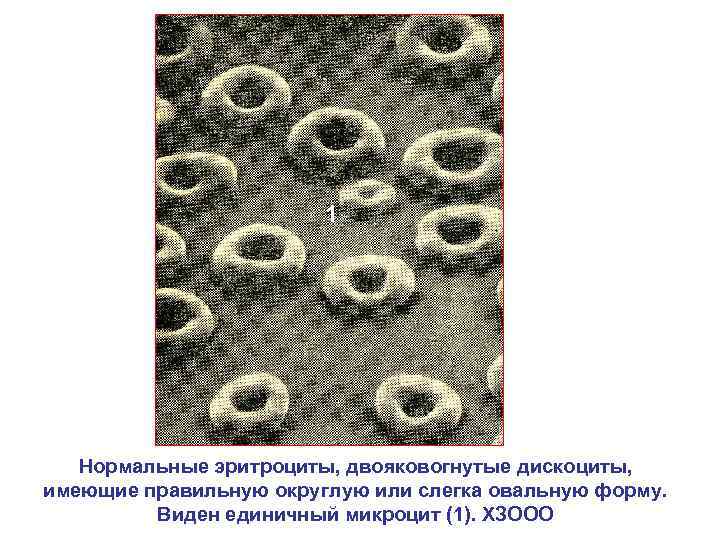 1 Нормальные эритроциты, двояковогнутые дискоциты, имеющие правильную округлую или слегка овальную форму. Виден единичный