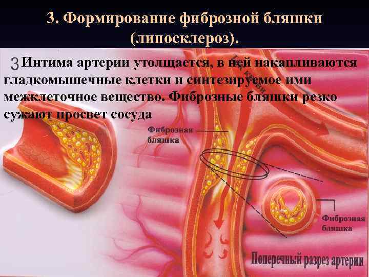 3. Формирование фиброзной бляшки (липосклероз). Интима артерии утолщается, в ней накапливаются гладкомышечные клетки и