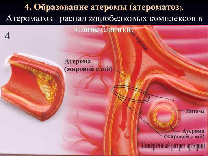 4. Образование атеромы (атероматоз). Атероматоз - распад жиробелковых комплексов в толще бляшки. 