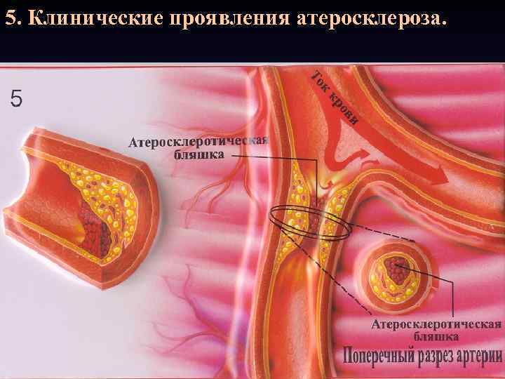 5. Клинические проявления атеросклероза. 