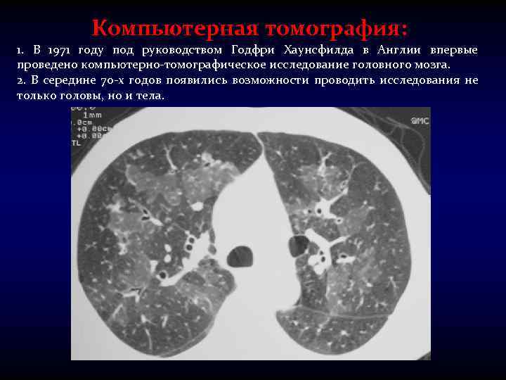 Компьютерная томография: 1. В 1971 году под руководством Годфри Хаунсфилда в Англии впервые проведено
