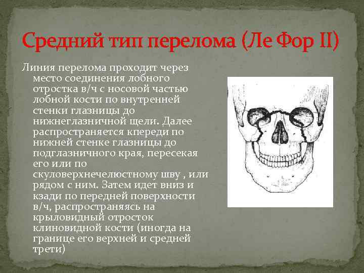 Средний тип. Перелом верхней челюсти по Лефор 2. Ле фор 2 линия перелома. Линия перелома по Лефор 3. Перелом по типу Лефор 1 рентген.