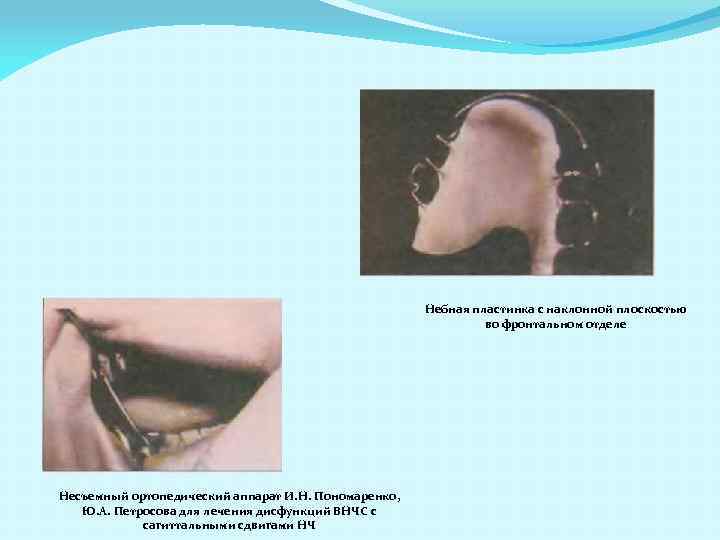Небная пластинка с наклонной плоскостью во фронтальном отделе Несъемный ортопедический аппарат И. Н. Пономаренко,