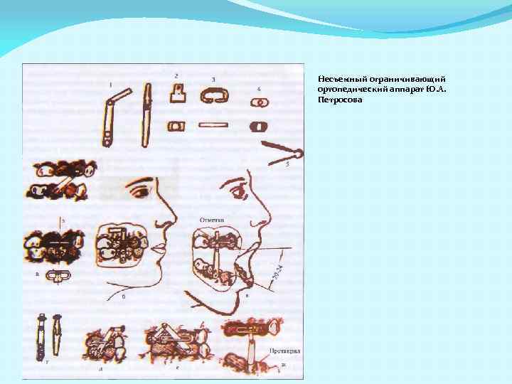 Несъемный ограничивающий ортопедический аппарат Ю. А. Петросова 