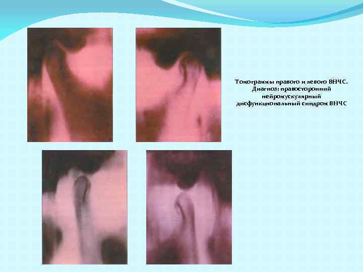 Томограммы правого и левого ВНЧС. Диагноз: правосторонний нейромускулярный дисфункциональный синдром ВНЧС 