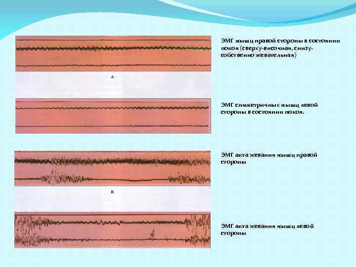 ЭМГ мышц правой стороны в состоянии покоя (сверху-височная, снизусобственно жевательная) ЭМГ симметричных мышц левой