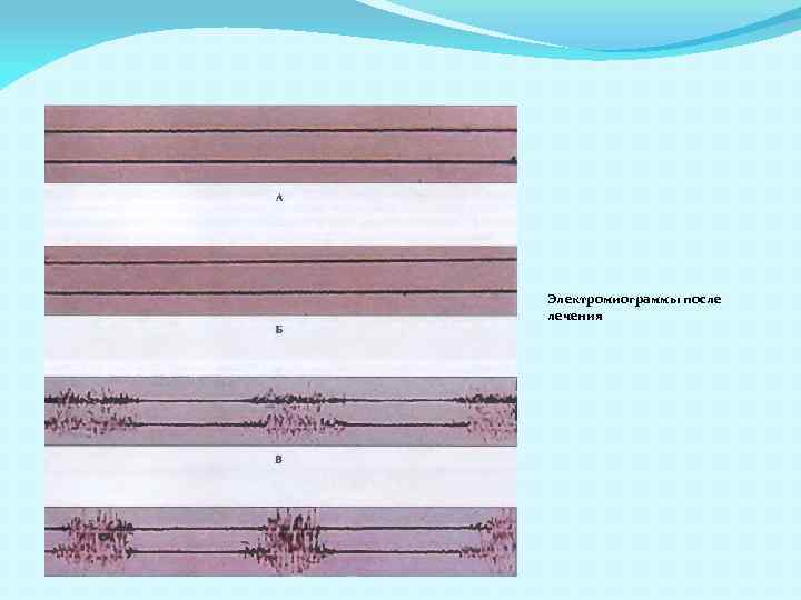 Электромиограммы после лечения 