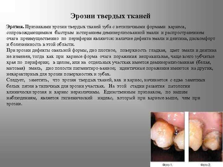 Эрозии твердых тканей Эрозия. Признаками эрозии твердых тканей зуба с нетипичными формами кариеса, сопровождающимися