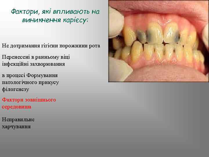 Фактори, які впливають на виникнення карієсу: Не дотримання гігієни порожнини рота Перенесені в ранньому