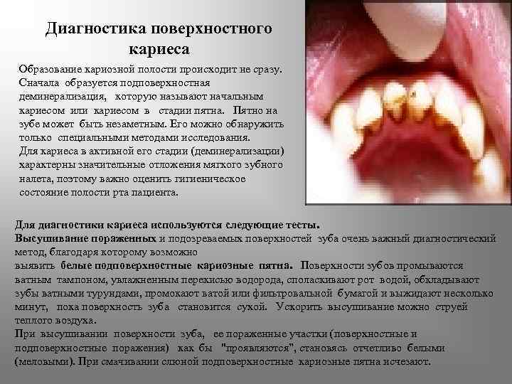 Диагностика поверхностного кариеса Образование кариозной полости происходит не сразу. Сначала образуется подповерхностная деминерализация, которую