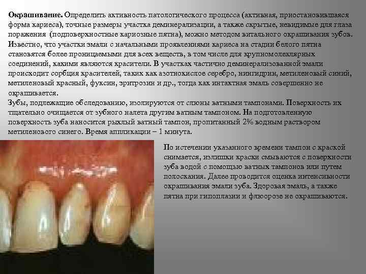Окрашивание. Определить активность патологического процесса (активная, приостановившаяся форма кариеса), точные размеры участка деминерализации, а
