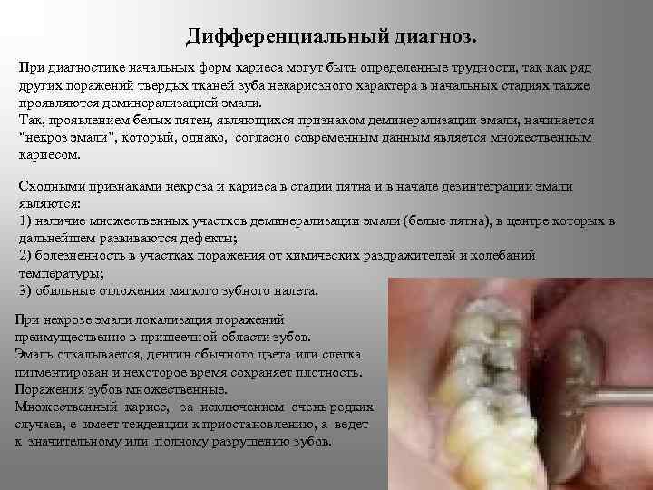 Дифференциальный диагноз. При диагностике начальных форм кариеса могут быть определенные трудности, так как ряд