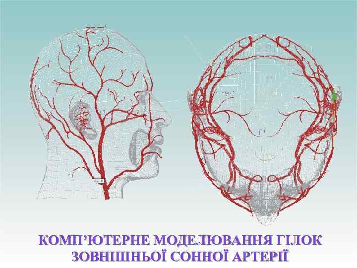 КОМП’ЮТЕРНЕ МОДЕЛЮВАННЯ ГІЛОК ЗОВНІШНЬОЇ СОННОЇ АРТЕРІЇ 