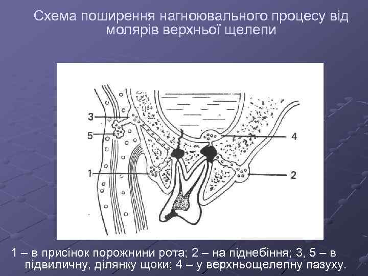 Схема поширення нагноювального процесу від молярів верхньої щелепи 1 – в присінок порожнини рота;