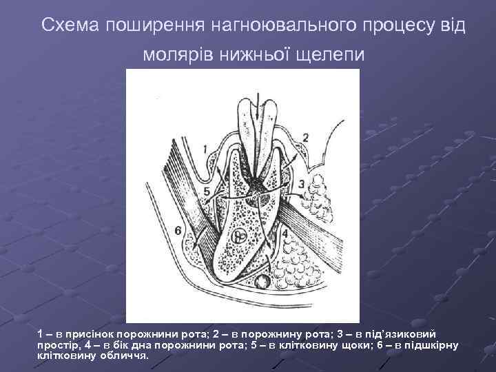 Схема поширення нагноювального процесу від молярів нижньої щелепи 1 – в присінок порожнини рота;