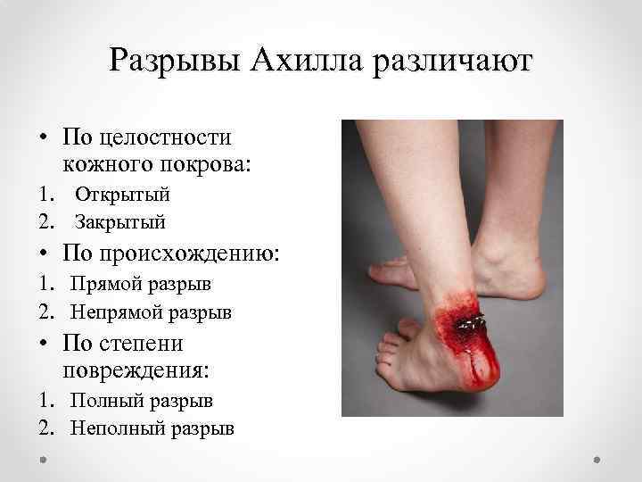 Разрывы Ахилла различают • По целостности кожного покрова: 1. Открытый 2. Закрытый • По
