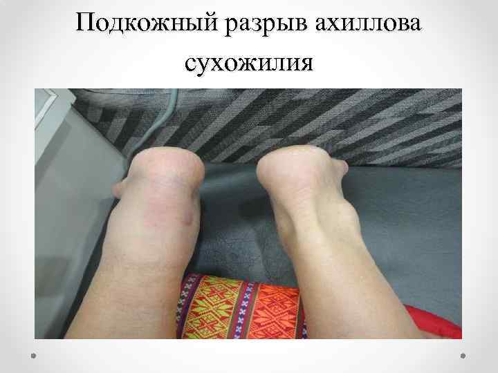 Подкожный разрыв ахиллова сухожилия 