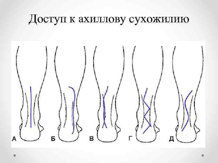 Доступ к ахиллову сухожилию 