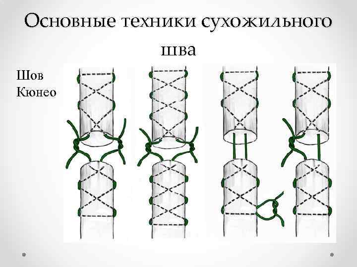 Основные техники сухожильного шва Шов Кюнео 