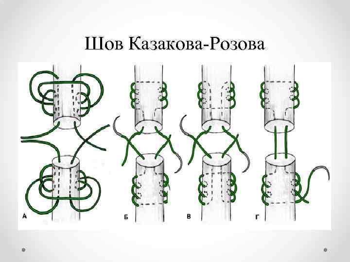 Шов Казакова-Розова 