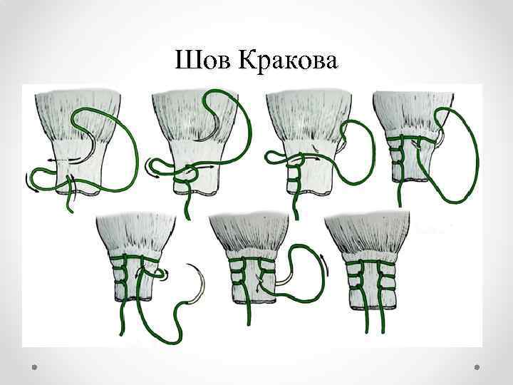 Шов Кракова 