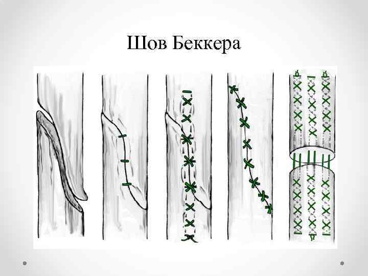 Шов Беккера 