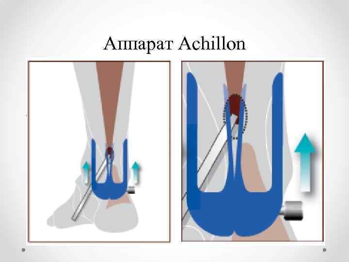 Аппарат Achillon 