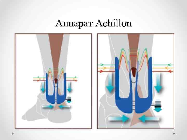 Аппарат Achillon 