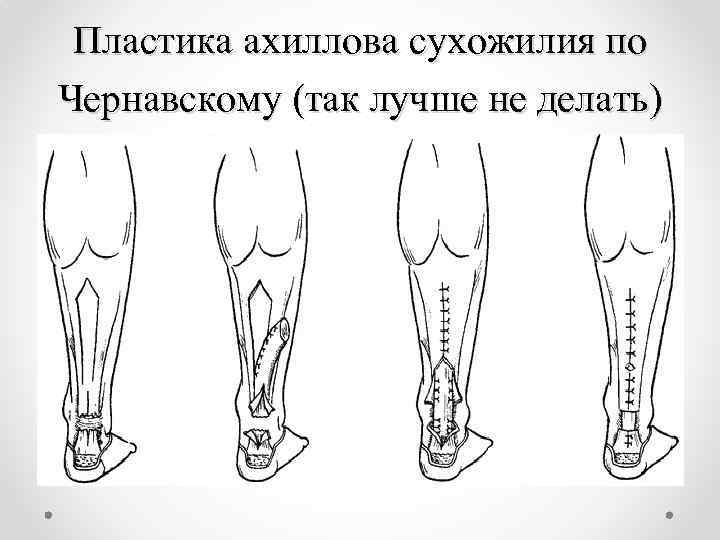 Пластика ахиллова сухожилия по Чернавскому (так лучше не делать) 