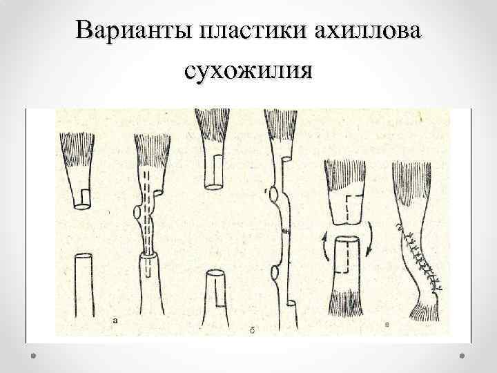 Варианты пластики ахиллова сухожилия 