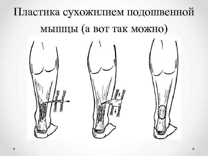 Пластика сухожилием подошвенной мышцы (а вот так можно) 