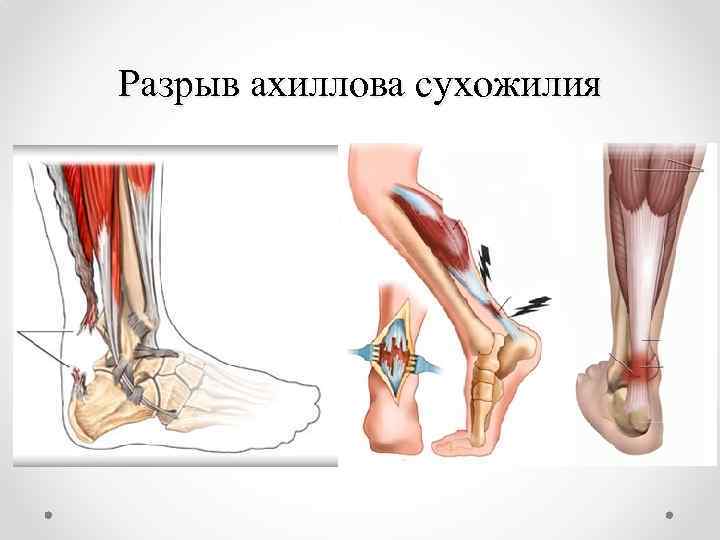 Разрыв ахиллова сухожилия 